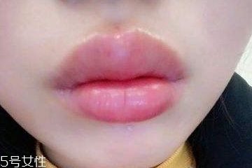 嘟嘟唇多少錢一針 價(jià)格不一 嘟嘟唇多少錢一針 價(jià)格不一