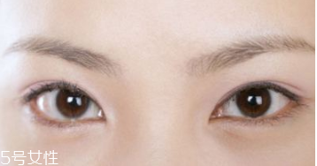 割雙眼皮后多久消腫呢 每個人的消腫時間不一樣 割雙眼皮后多久消腫呢 每個人的消腫時間不一樣