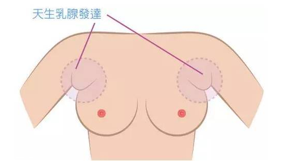 假副乳和真副乳的區(qū)別 前者能快速消除 假副乳和真副乳的區(qū)別 前者能快速消除