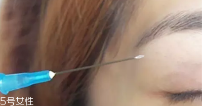 納米無(wú)痕雙眼皮是埋線嗎 納米無(wú)痕雙眼皮介紹 納米無(wú)痕雙眼皮是埋線嗎 納米無(wú)痕雙眼皮介紹