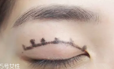 納米無(wú)痕雙眼皮是埋線嗎 納米無(wú)痕雙眼皮介紹 納米無(wú)痕雙眼皮是埋線嗎 納米無(wú)痕雙眼皮介紹