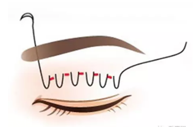 納米無(wú)痕雙眼皮是埋線嗎 納米無(wú)痕雙眼皮介紹 納米無(wú)痕雙眼皮是埋線嗎 納米無(wú)痕雙眼皮介紹