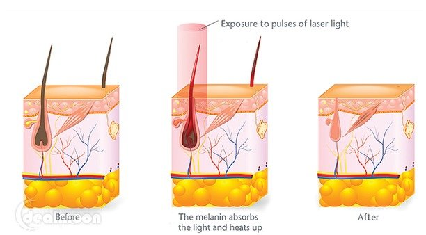 博朗脫毛儀使用教程 博朗脫毛儀優(yōu)缺點(diǎn)介紹 博朗脫毛儀使用教程 博朗脫毛儀優(yōu)缺點(diǎn)介紹