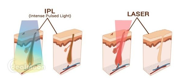 博朗脫毛儀使用教程 博朗脫毛儀優(yōu)缺點(diǎn)介紹 博朗脫毛儀使用教程 博朗脫毛儀優(yōu)缺點(diǎn)介紹