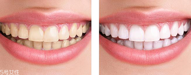 佳潔士美白牙貼有害嗎 不會傷害到牙釉質 佳潔士美白牙貼有害嗎 不會傷害到牙釉質