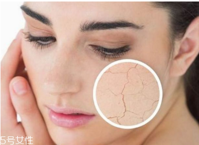 皮膚干燥起皮怎么辦？該如何保養(yǎng)