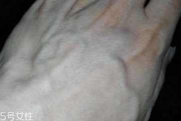 男性青筋凸起要注意 是個(gè)慢性炸彈 男性青筋凸起要注意 是個(gè)慢性炸彈