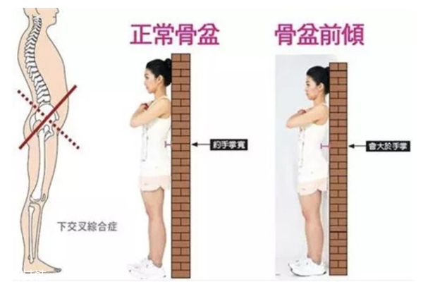 骨盆前傾怎么判斷 這個(gè)簡單方法看出假翹臀 骨盆前傾怎么判斷 這個(gè)簡單方法看出假翹臀