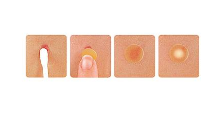 痘痘貼怎么用 痘痘貼原理 痘痘貼怎么用 痘痘貼原理