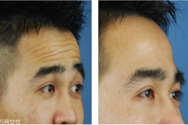 抬頭紋怎么去除？小妙招教給你