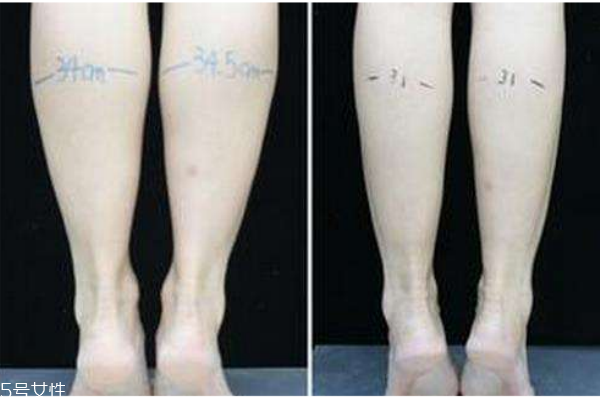 小腿吸脂后遺癥你知道多少？