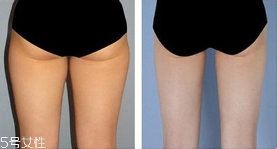 小腿吸脂后遺癥你知道多少？