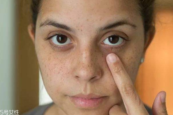 曬后多久會(huì)變黑 3天后皮膚就會(huì)變黑 曬后多久會(huì)變黑 3天后皮膚就會(huì)變黑