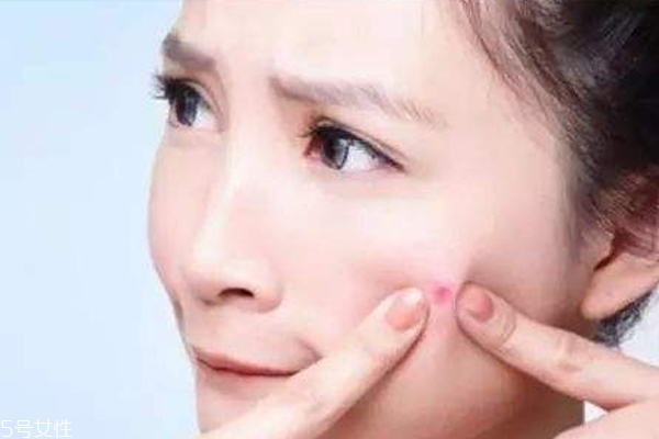 什么痘痘不能擠 這種痘擠破一定會(huì)留疤 什么痘痘不能擠 這種痘擠破一定會(huì)留疤