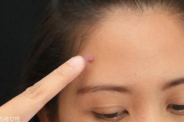 什么痘痘不能擠 這種痘擠破一定會(huì)留疤 什么痘痘不能擠 這種痘擠破一定會(huì)留疤