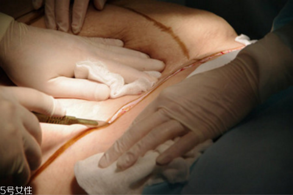 感冒的時(shí)候能進(jìn)行抽脂手術(shù)嗎 感冒的時(shí)候能進(jìn)行抽脂手術(shù)嗎