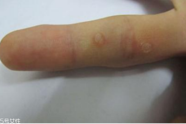 手上長了個(gè)硬疙瘩怎么回事 手上長了個(gè)硬疙瘩像繭 手上長了個(gè)硬疙瘩怎么回事 手上長了個(gè)硬疙瘩像繭