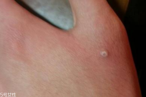 手上長了個(gè)硬疙瘩怎么回事 手上長了個(gè)硬疙瘩像繭 手上長了個(gè)硬疙瘩怎么回事 手上長了個(gè)硬疙瘩像繭