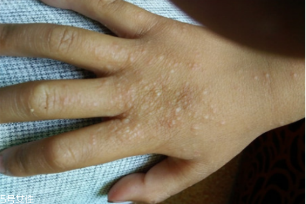 手上長了個(gè)硬疙瘩怎么回事 手上長了個(gè)硬疙瘩像繭 手上長了個(gè)硬疙瘩怎么回事 手上長了個(gè)硬疙瘩像繭