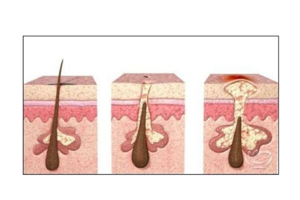 頭發(fā)白是什么原因引起的 不能治愈的白發(fā)病 頭發(fā)白是什么原因引起的 不能治愈的白發(fā)病