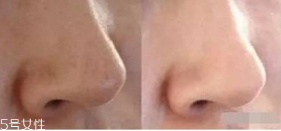 痘痘肌怎么調(diào)理 首先得對癥下藥 痘痘肌怎么調(diào)理 首先得對癥下藥