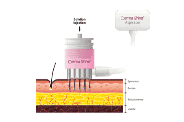 水光針是什么東西 水光針是什么東西