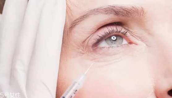 去眼部皺紋最好的方法 魚尾紋除皺方法 去眼部皺紋最好的方法 魚尾紋除皺方法