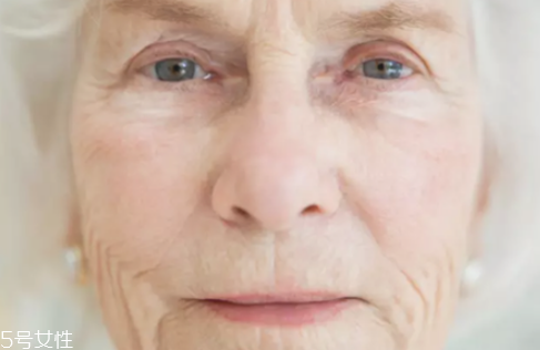 去眼部皺紋最好的方法 魚尾紋除皺方法 去眼部皺紋最好的方法 魚尾紋除皺方法