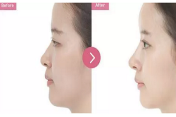 除皺針與玻尿酸哪個(gè)更好 除皺針和玻尿酸的區(qū)別 除皺針與玻尿酸哪個(gè)更好 除皺針和玻尿酸的區(qū)別