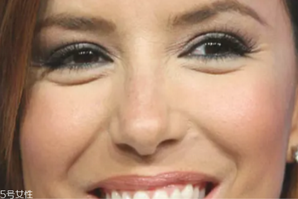 魚尾紋打玻尿酸管事嗎 快速秒殺眼部皺紋的方法 魚尾紋打玻尿酸管事嗎 快速秒殺眼部皺紋的方法