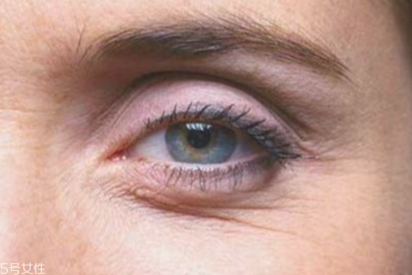 魚尾紋打玻尿酸管事嗎 快速秒殺眼部皺紋的方法 魚尾紋打玻尿酸管事嗎 快速秒殺眼部皺紋的方法