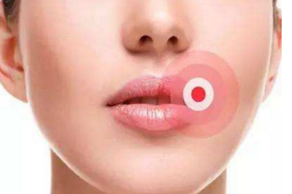 口角炎吃什么 口角炎原因 口角炎吃什么 口角炎原因