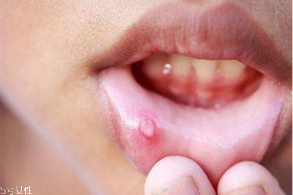 口角炎吃什么 口角炎原因 口角炎吃什么 口角炎原因