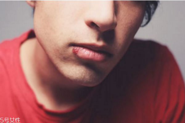 口角炎吃什么 口角炎原因 口角炎吃什么 口角炎原因