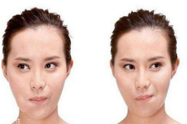 口角炎吃什么 口角炎原因 口角炎吃什么 口角炎原因