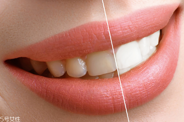 佳潔士電動(dòng)牙刷好用嗎 給牙齒做個(gè)美白spa 佳潔士電動(dòng)牙刷好用嗎 給牙齒做個(gè)美白spa