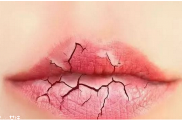 冬季如何護唇 護唇小妙招 冬季如何護唇 護唇小妙招