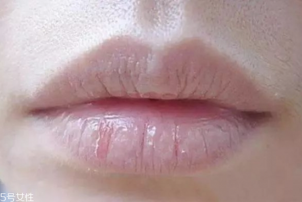 冬季如何護唇 護唇小妙招 冬季如何護唇 護唇小妙招