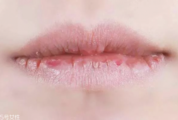 冬季如何護唇 護唇小妙招 冬季如何護唇 護唇小妙招