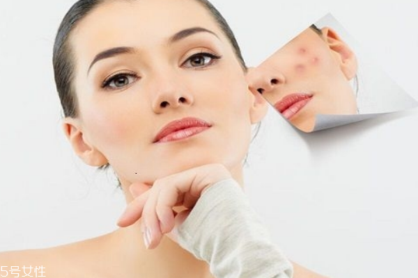 痘痘肌適合用什么護膚品 這五個口碑超好