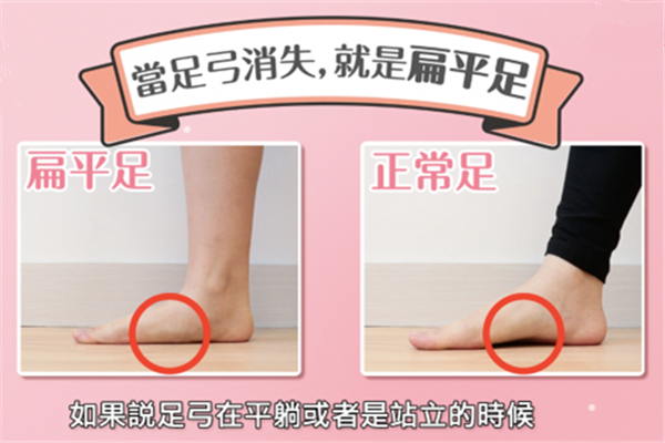 什么是扁平足 確診為扁平足要怎么恢復 什么是扁平足 確診為扁平足要怎么恢復