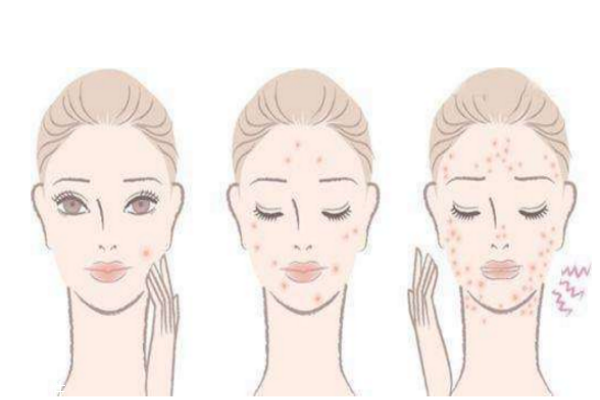 去痘印最快的方法 去痘印的護(hù)膚品推薦 去痘印最快的方法 去痘印的護(hù)膚品推薦