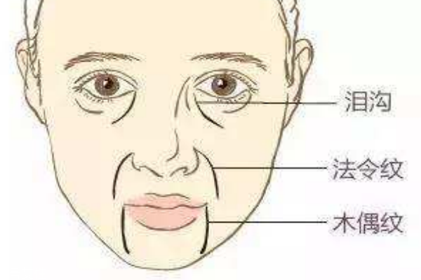 木偶紋怎么消除 讓你笑起來更自信 木偶紋怎么消除 讓你笑起來更自信