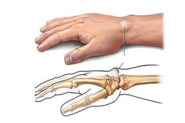 腱鞘炎是怎么引起的 教你告別鼠標手 腱鞘炎是怎么引起的 教你告別鼠標手