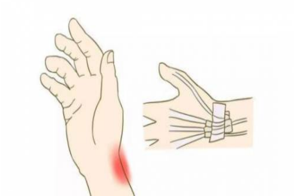 腱鞘炎是怎么引起的 教你告別鼠標手 腱鞘炎是怎么引起的 教你告別鼠標手