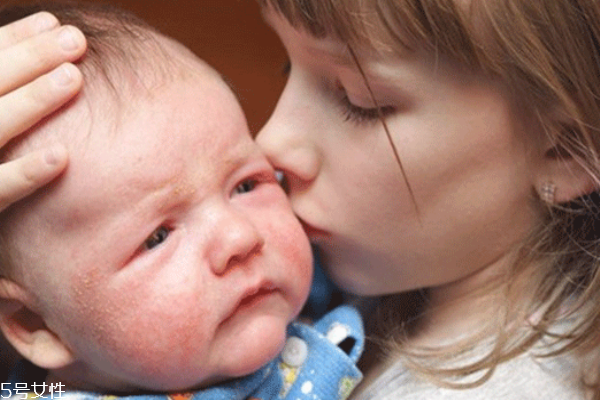 寶寶濕疹怎么辦 生活上要注意 寶寶濕疹怎么辦 生活上要注意