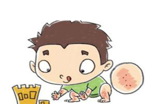 神經(jīng)性皮炎是什么 怎么護理 神經(jīng)性皮炎是什么 怎么護理