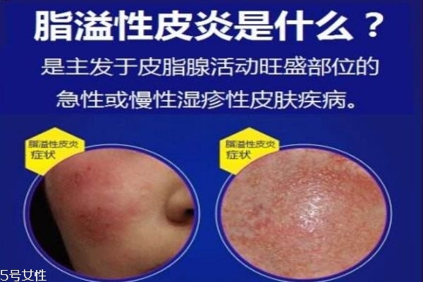 脂溢性皮炎癥狀 怎么預(yù)防