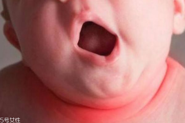 淹脖子是什么 怎么預(yù)防 淹脖子是什么 怎么預(yù)防