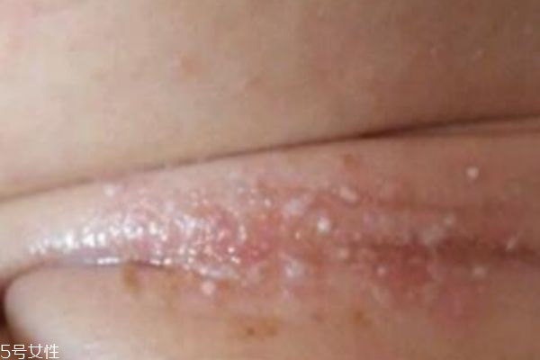 淹脖子是什么 怎么預(yù)防 淹脖子是什么 怎么預(yù)防